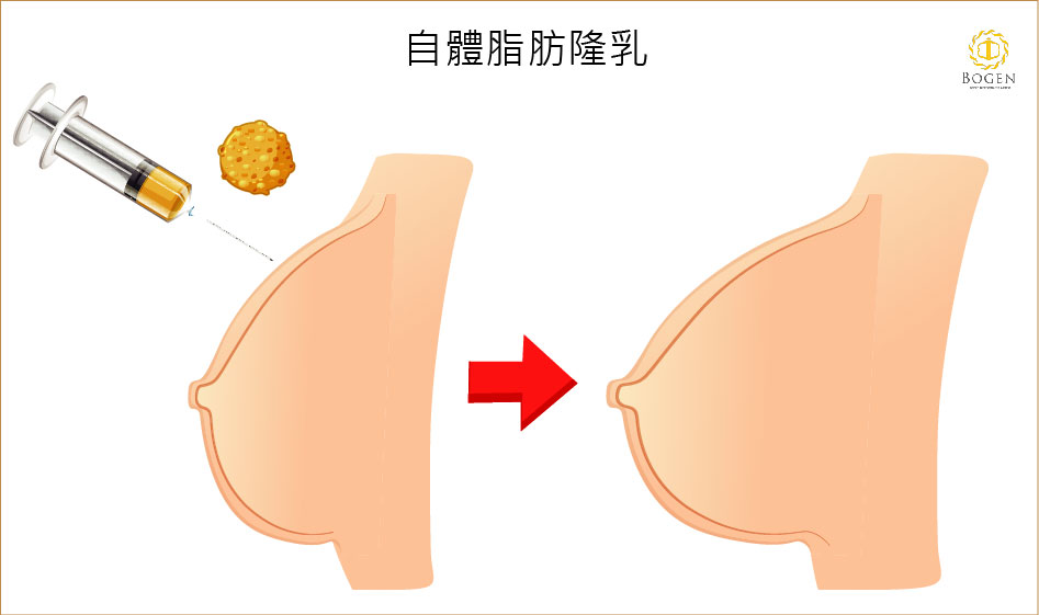 產後抽脂豐胸,自體脂肪隆乳,抽脂豐胸,博恩妍